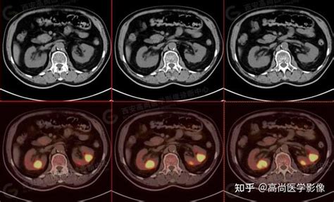 PET CT病例肺鳞癌5例高尚医学影像 知乎