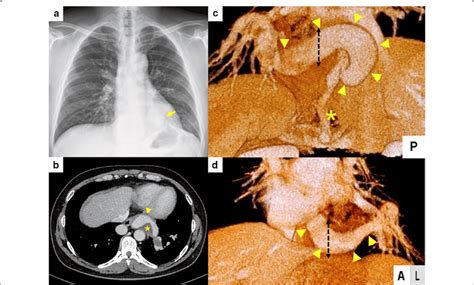 Preoperative Chest X Ray And Computed Tomography Images A Chest X Ray