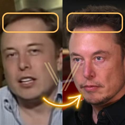 Elon Musk Hair Transplant Before And After Transformation