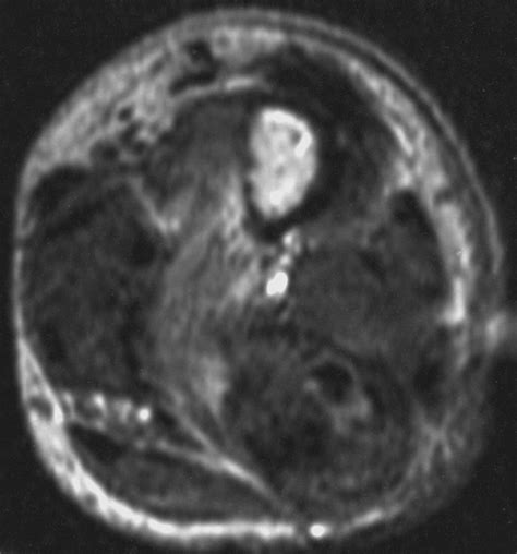 Imaging Findings In Desmoplastic Fibroma Of Bone Distinctive T2