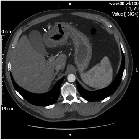 Partial Malrotation Of The Bowel In An Adult Patient Presenting With Abdominal Pain Bmj Case