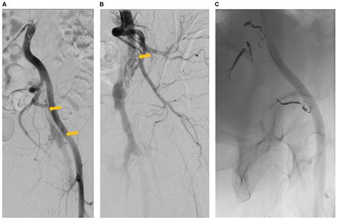 Closure Of Post Thrombotic Iliac Arteriovenous Fistulas By Iliac Vein