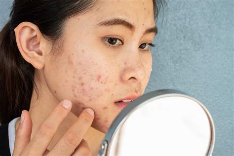 3 Treatments For Pitted Atrophic Acne Scars