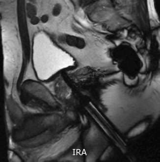 MRI Guided Biopsy Radiology Key