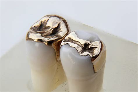 What Are Dental Inlay and Onlay? - GlobalDentalPro