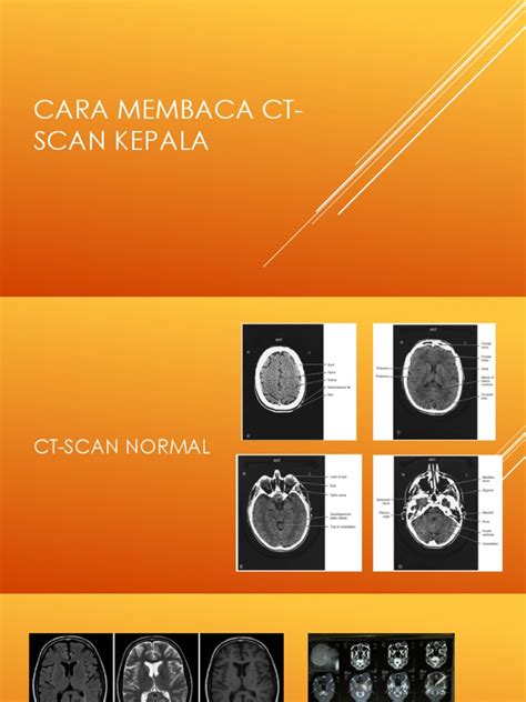 Cara Membaca Ct Scan Kepala