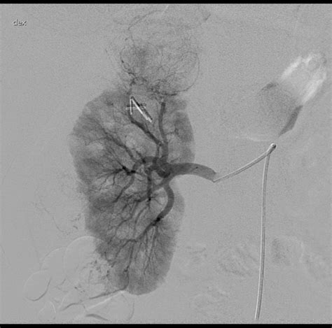 Selective Angiography Of The Right Renal Artery Showed Hypervascular