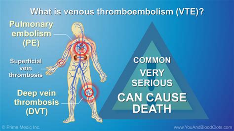 Preventing And Treating Venous Thromboembolism Vte