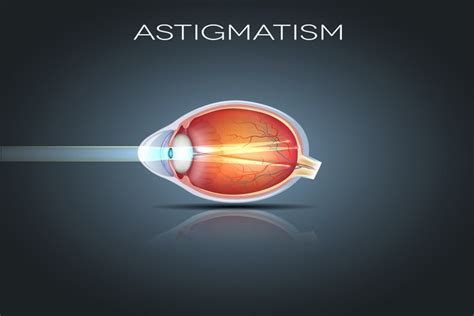 What Is Astigmatism Symptoms Causes Diagnosis Treatment Page 7 Of