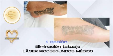 Eliminar Tatuajes Con L Ser Cema Cl Nic Vilanova