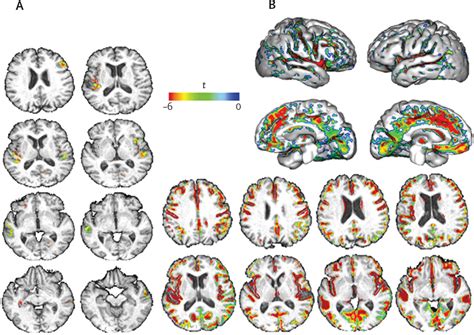 Effects Of Systolic Blood Pressure On White Matter Integrity In Young