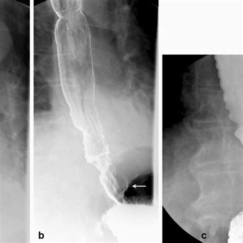 59 Year Old Male With History Of Esophageal Perforation Secondary To