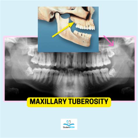 Panoramic Radiograph Landmarks Flashcards Quizlet