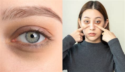 Reason Of Bags Under Eyes And Mild Swelling Or Puffiness Under The Eyes सिर्फ नींद की कमी से