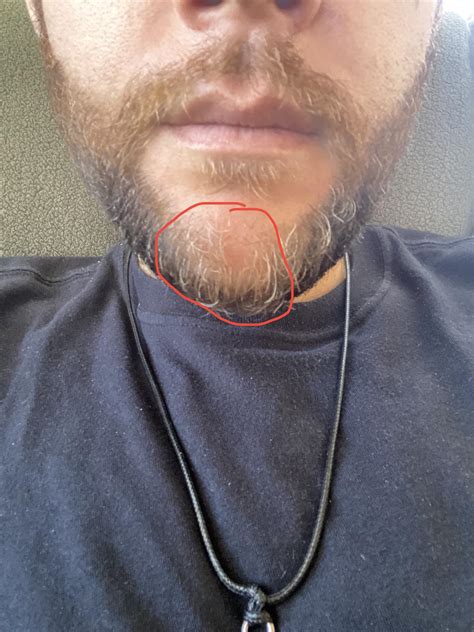 How common is this bald spot? : r/beards