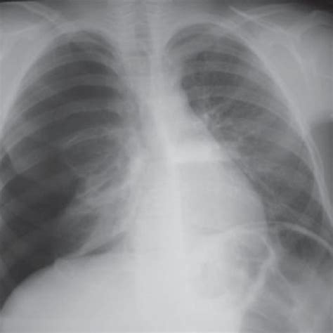 Pneumotórax de pequeno volume à direita Área de enfi sema focal no