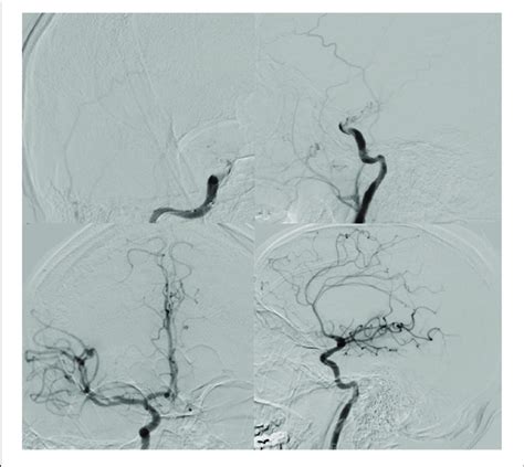 Top Ap Left And Lateral Right Digital Subtraction Angiogram