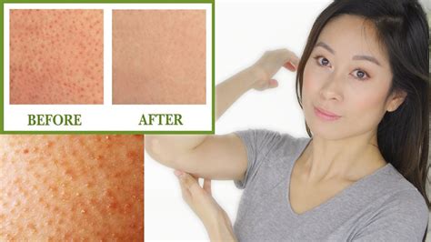 Keratosis Pilaris Treatment Bumps On Skin Chicken Skin Vivienne