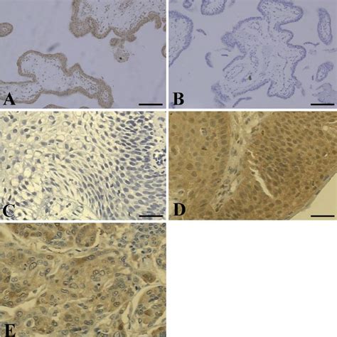 Human Leukocyte Antigen G Hla G Expression In Patients With Invasive