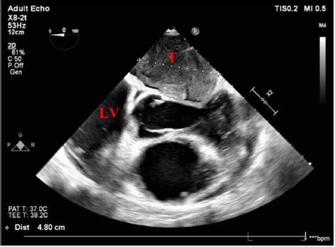 Single View On Transesophageal Echocardiogram Tee Demonstrating Near Download Scientific