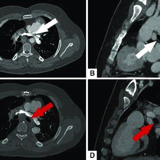 A And B Preoperative Computed Tomography Ct Angiogram Demonstrating