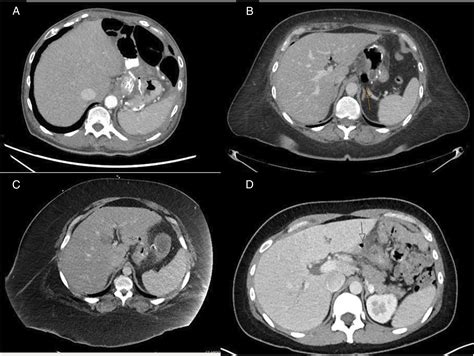 Non Operative Approach To Contained Perforated Marginal Ulcers A