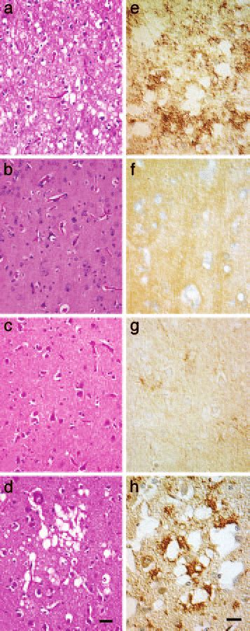 Routine Histology And Prp Sc Ihc On Brain Sections Of Two Cjd Patients