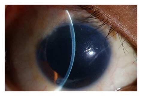 Clinical picture on presentation showing corneal edema, peripheral ...