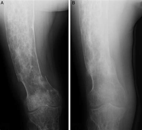 Pathological Fracture Femur