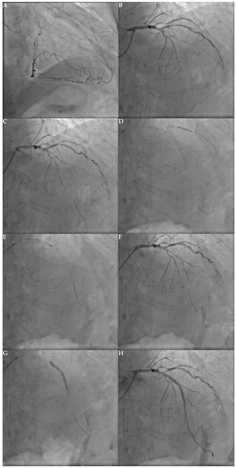 Jcm Free Full Text Percutaneous Coronary Intervention For Chronic