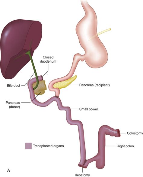 Combined Liver and Small Bowel Transplantation | Abdominal Key