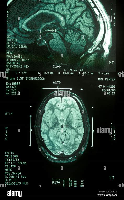 Human brain mri Stock Photo - Alamy