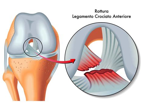 Operaci N Y Rehabilitaci N Del Ligamento Cruzado Anterior Ese Gran