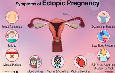 Ectopic Pregnancy Nurses Revision