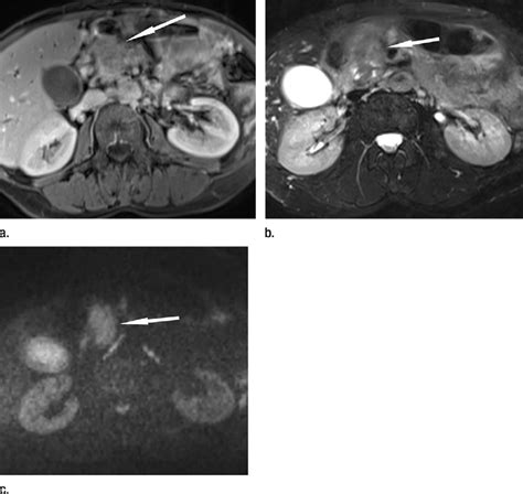 Images In 63 Year Old Woman With Moderately Differentiated Pancreatic Download Scientific