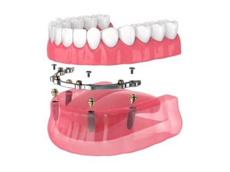 What Is The Bar Attachment Denture Dental Implant Technique