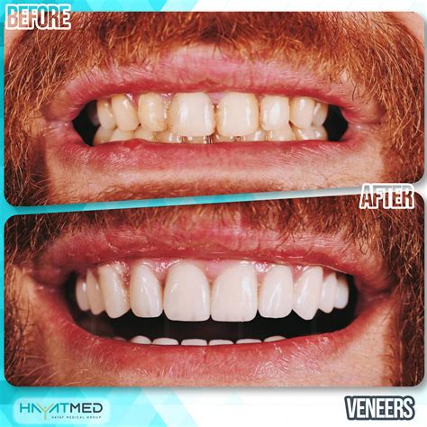 Cost Of Veneers In Turkey Best Quality Real Guarantee