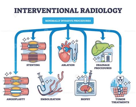 Interventional Radiology As Minimally Invasive Procedures Outline