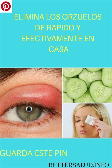 Como Quitar Un Orzuelo En El Ojo Rapido Consejos Ojos