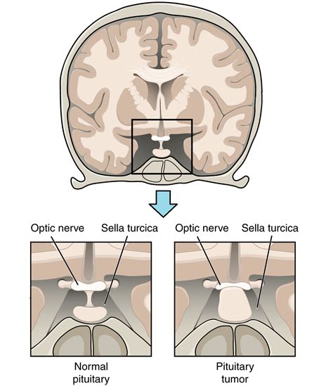 Pituitary Tumor Optic Chiasm