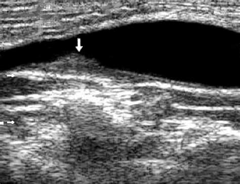 Soft Plaque On Posterior Wall Of Bifurcation Of Oca Arrow Local Download Scientific Diagram