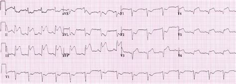 Acute Myocardial Infarction Ecg