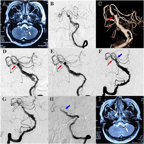 Frontiers Case Report Late In Stent Thrombosis In A Patient With