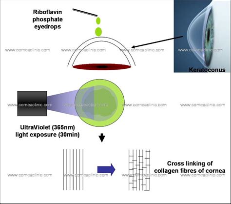 Collagen Crosslinking Using Riboflavin And Uva Exposure For Keratoconus