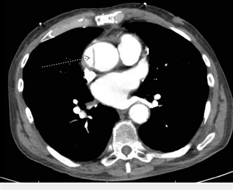 Figure From Incidental Finding Of Thoracic Aortic Dissection In A