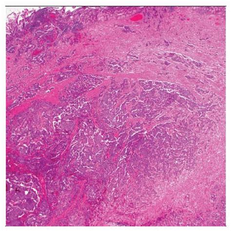 Paraganglioma | Basicmedical Key