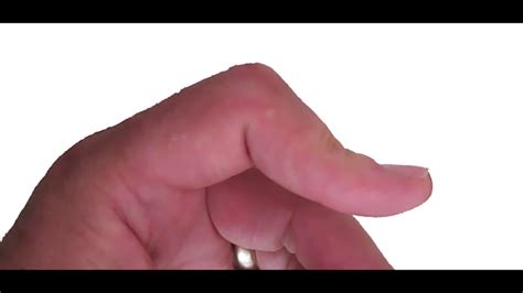 Ot Rex Avulsion Injuries Mallet Finger Boutonniere Swan Neck Deformity Youtube