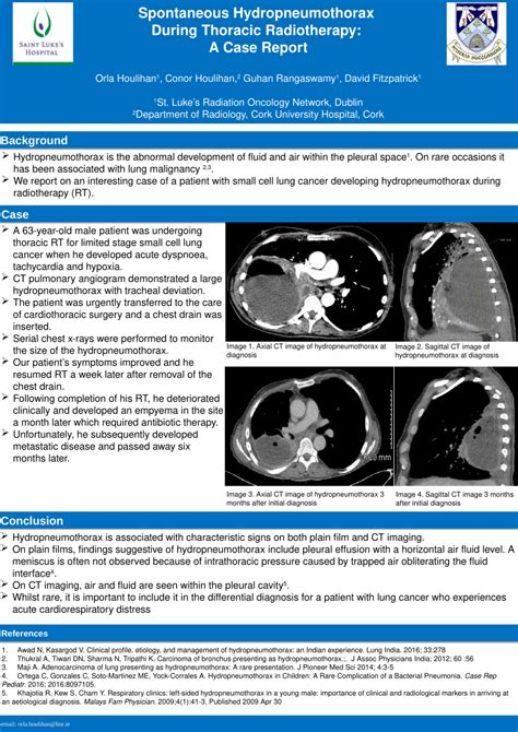 PDF Spontaneous Hydropneumothorax During Thoracic Radiotherapy A