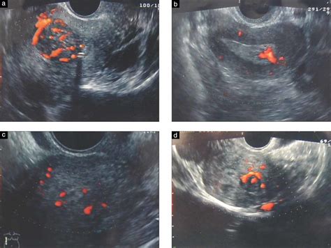 Power Doppler Properties Of Endometrial Polyps And Submucosal Fibroids