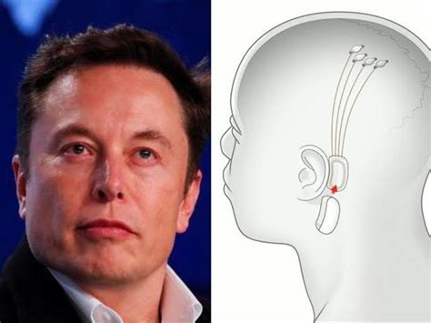 Elon Musks Neuralink To Start Human Trial Of Brain Implant For